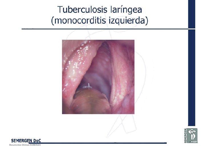 Tuberculosis laríngea (monocorditis izquierda) 