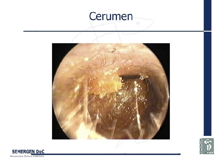 Cerumen 