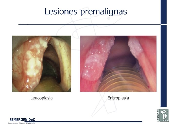 Lesiones premalignas 