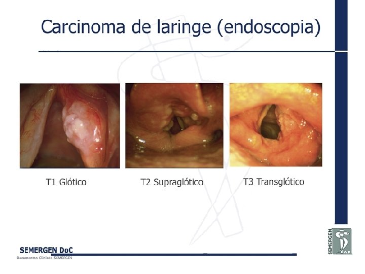 Carcinoma de laringe (endoscopia) 