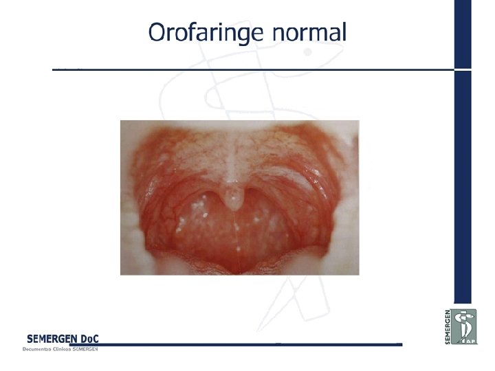 Orofaringe normal 