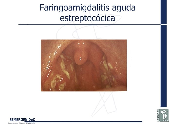 Faringoamigdalitis aguda estreptocócica 