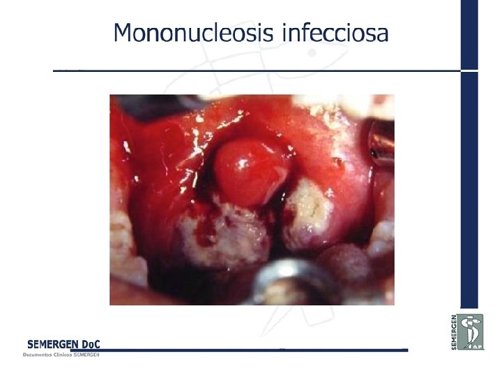 Mononucleosis infecciosa 