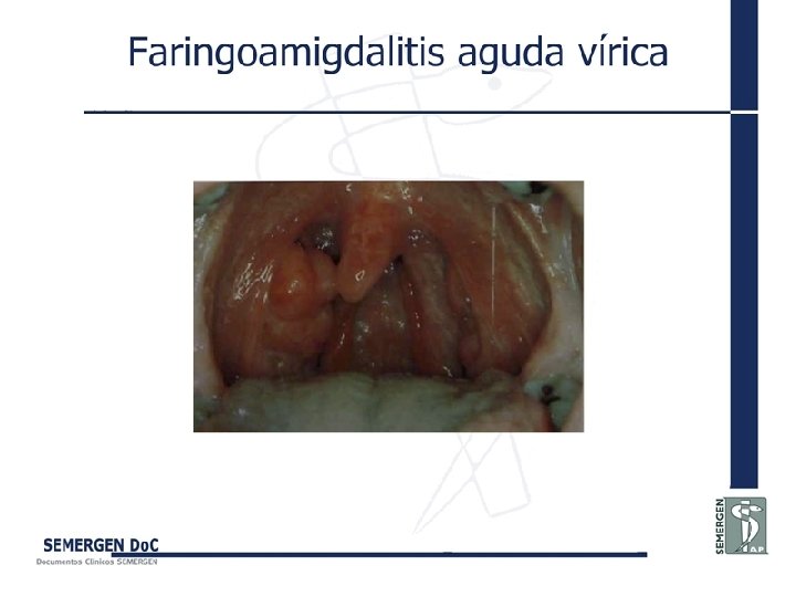 Faringoamigdalitis aguda vírica 