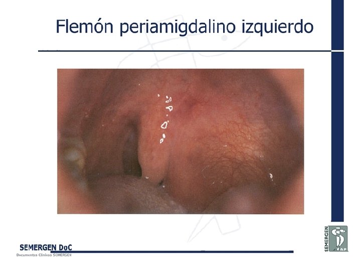 Flemón periamigdalino izquierdo 