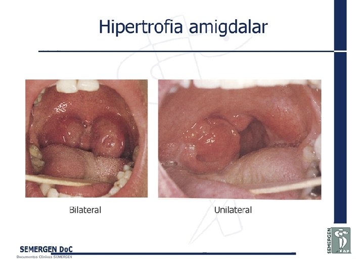 Hipertrofia amigdalar 