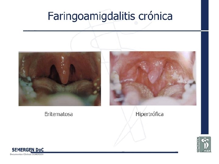 Faringoamigdalitis crónica 