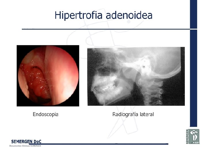 Hipertrofia adenoidea 