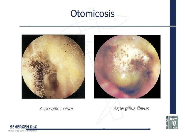 Otomicosis 