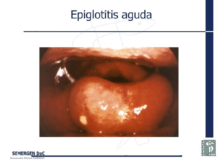 Epiglotitis aguda 