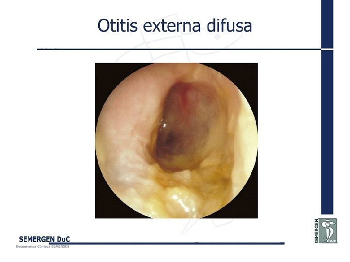 Otitis externa difusa 