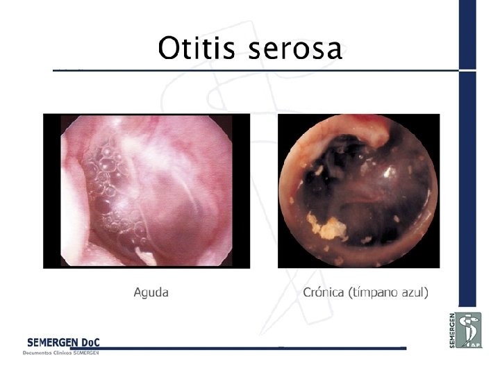 Otitis serosa 