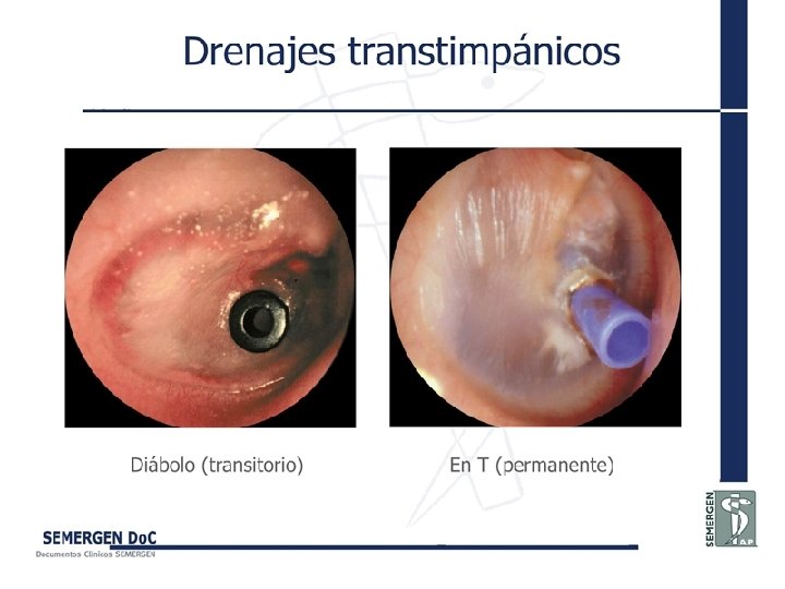 Drenajes transtimpánicos 