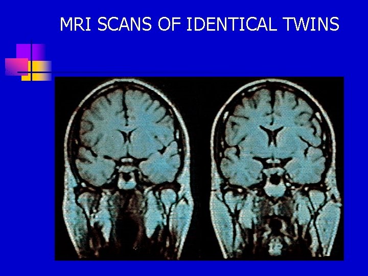 MRI SCANS OF IDENTICAL TWINS 