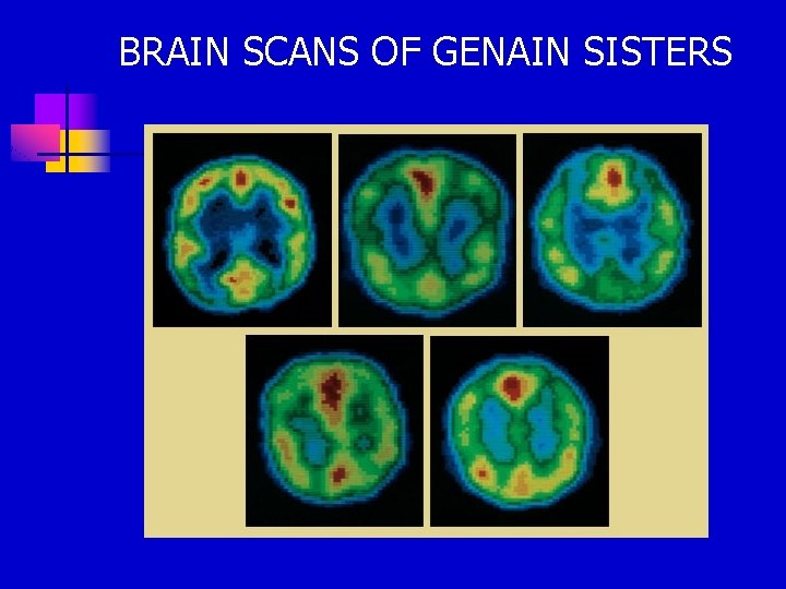 BRAIN SCANS OF GENAIN SISTERS 