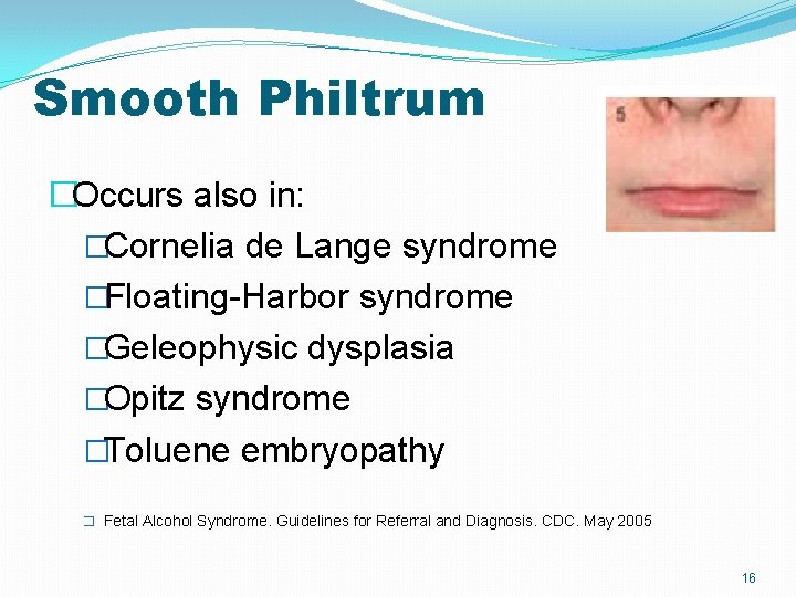 Smooth Philtrum �Occurs also in: �Cornelia de Lange syndrome �Floating-Harbor syndrome �Geleophysic dysplasia �Opitz Smooth Philtrum �Occurs also in: �Cornelia de Lange syndrome �Floating-Harbor syndrome �Geleophysic dysplasia �Opitz