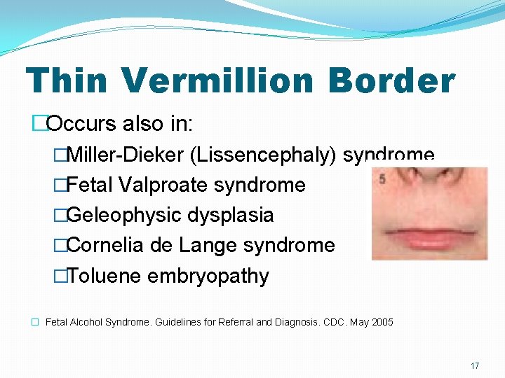 Thin Vermillion Border �Occurs also in: �Miller-Dieker (Lissencephaly) syndrome �Fetal Valproate syndrome �Geleophysic dysplasia Thin Vermillion Border �Occurs also in: �Miller-Dieker (Lissencephaly) syndrome �Fetal Valproate syndrome �Geleophysic dysplasia