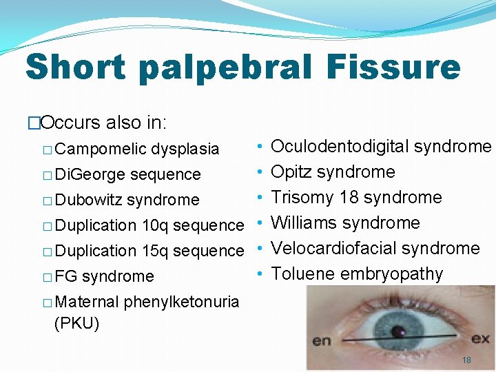 Short palpebral Fissure �Occurs also in: • • � Di. George sequence • � Short palpebral Fissure �Occurs also in: • • � Di. George sequence • �
