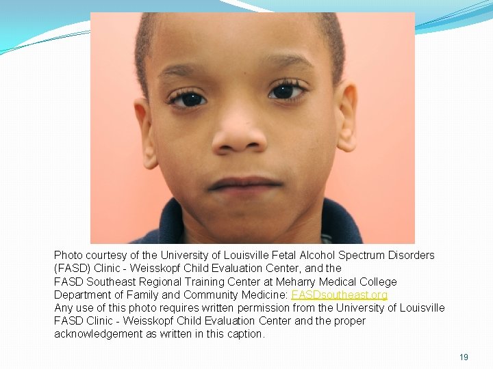 Photo courtesy of the University of Louisville Fetal Alcohol Spectrum Disorders (FASD) Clinic - Photo courtesy of the University of Louisville Fetal Alcohol Spectrum Disorders (FASD) Clinic -