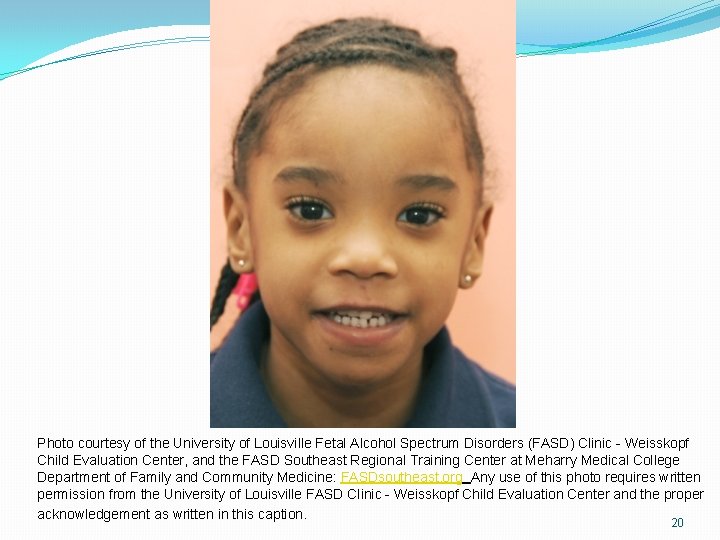 Photo courtesy of the University of Louisville Fetal Alcohol Spectrum Disorders (FASD) Clinic - Photo courtesy of the University of Louisville Fetal Alcohol Spectrum Disorders (FASD) Clinic -