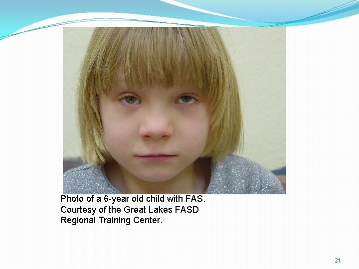 Photo of a 6 -year old child with FAS. Courtesy of the Great Lakes Photo of a 6 -year old child with FAS. Courtesy of the Great Lakes