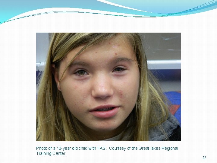 Photo of a 13 -year old child with FAS. Courtesy of the Great lakes Photo of a 13 -year old child with FAS. Courtesy of the Great lakes