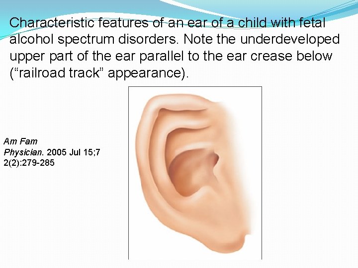 Characteristic features of an ear of a child with fetal alcohol spectrum disorders. Note Characteristic features of an ear of a child with fetal alcohol spectrum disorders. Note