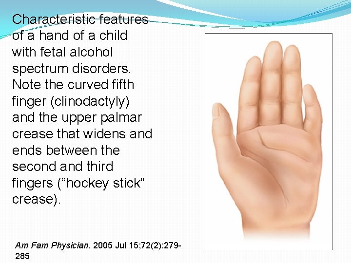 Characteristic features of a hand of a child with fetal alcohol spectrum disorders. Note Characteristic features of a hand of a child with fetal alcohol spectrum disorders. Note
