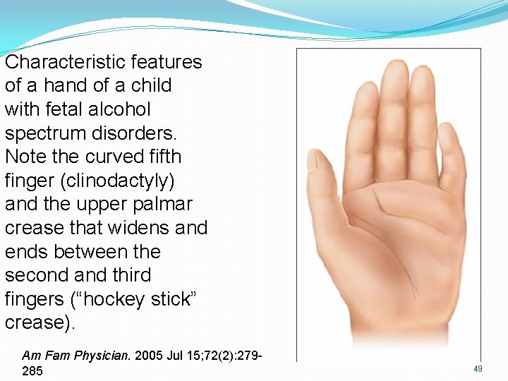 Characteristic features of a hand of a child with fetal alcohol spectrum disorders. Note Characteristic features of a hand of a child with fetal alcohol spectrum disorders. Note