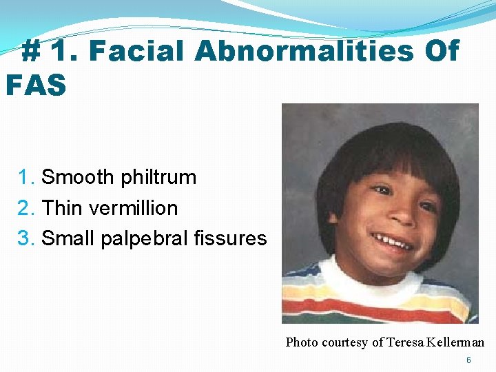 # 1. Facial Abnormalities Of FAS 1. Smooth philtrum 2. Thin vermillion 3. Small # 1. Facial Abnormalities Of FAS 1. Smooth philtrum 2. Thin vermillion 3. Small