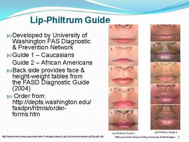 Lip-Philtrum Guide Developed by University of Washington FAS Diagnostic & Prevention Network Guide 1 Lip-Philtrum Guide Developed by University of Washington FAS Diagnostic & Prevention Network Guide 1