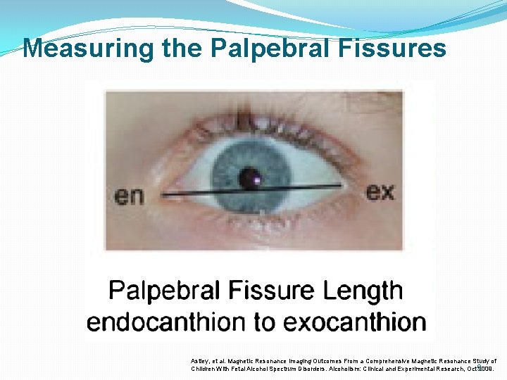 Measuring the Palpebral Fissures Astley, et al. Magnetic Resonance Imaging Outcomes From a Comprehensive Measuring the Palpebral Fissures Astley, et al. Magnetic Resonance Imaging Outcomes From a Comprehensive