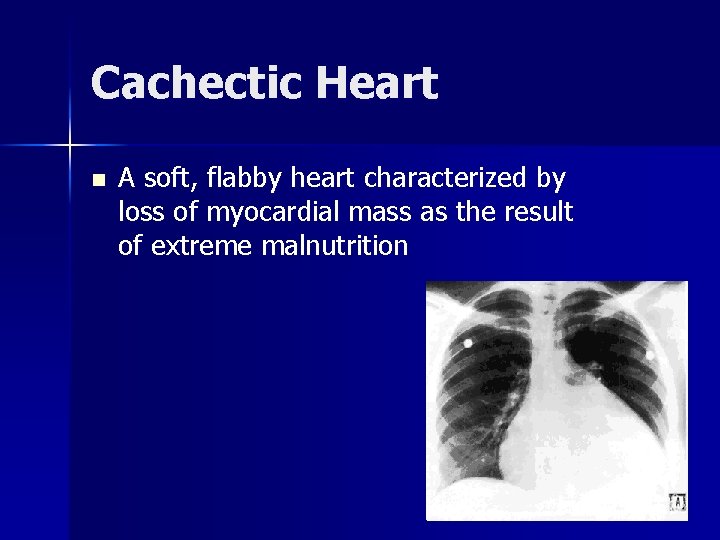 Cachectic Heart n A soft, flabby heart characterized by loss of myocardial mass as