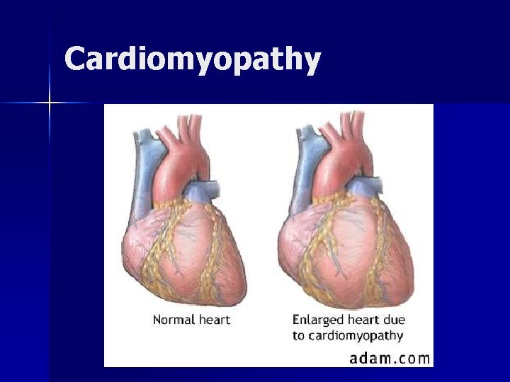 Cardiomyopathy 