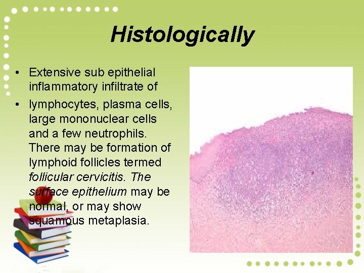 Histologically • Extensive sub epithelial inflammatory infiltrate of • lymphocytes, plasma cells, large mononuclear