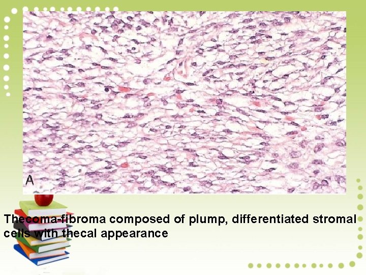 Thecoma-fibroma composed of plump, differentiated stromal cells with thecal appearance 