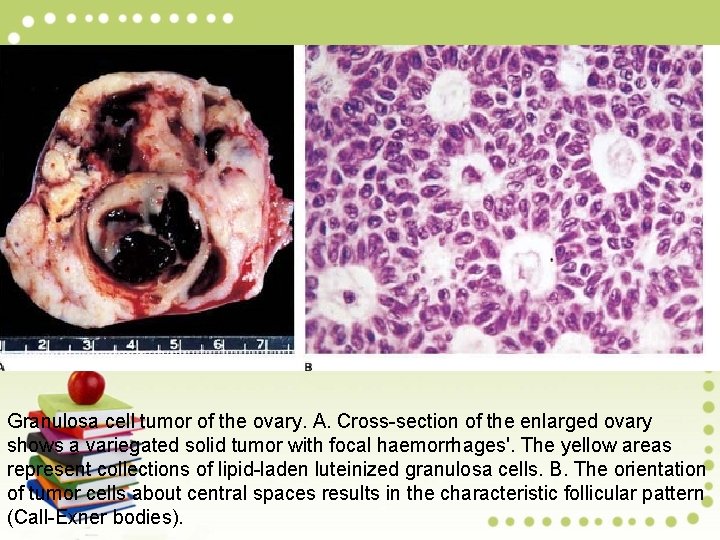 Granulosa cell tumor of the ovary. A. Cross-section of the enlarged ovary shows a