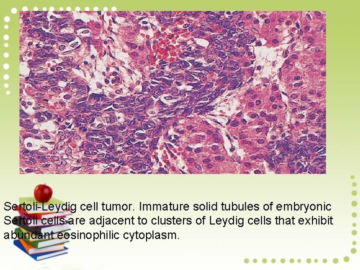 Sertoli-Leydig cell tumor. Immature solid tubules of embryonic Sertoli cells are adjacent to clusters