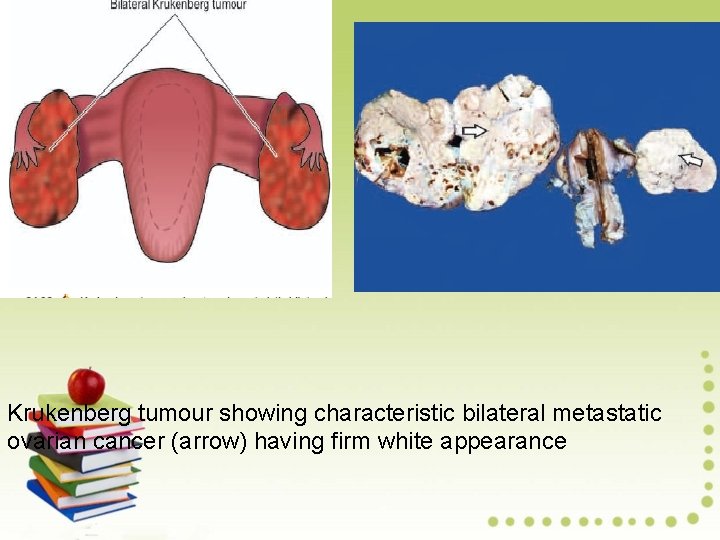 Krukenberg tumour showing characteristic bilateral metastatic ovarian cancer (arrow) having firm white appearance 