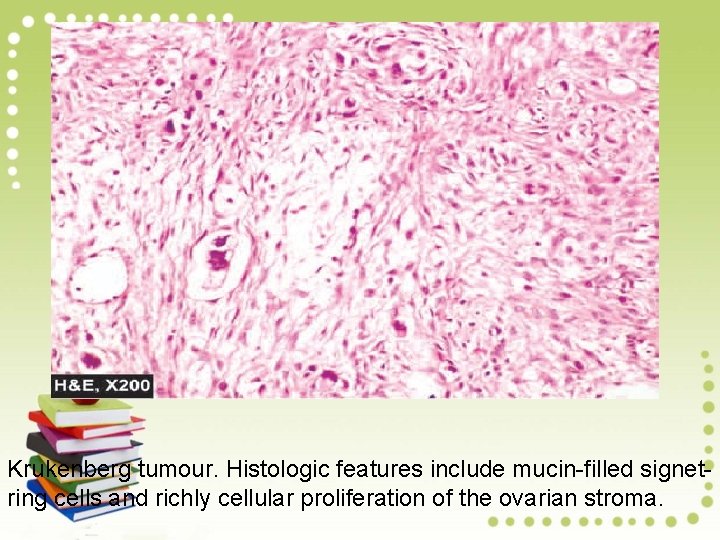 Krukenberg tumour. Histologic features include mucin-filled signetring cells and richly cellular proliferation of the