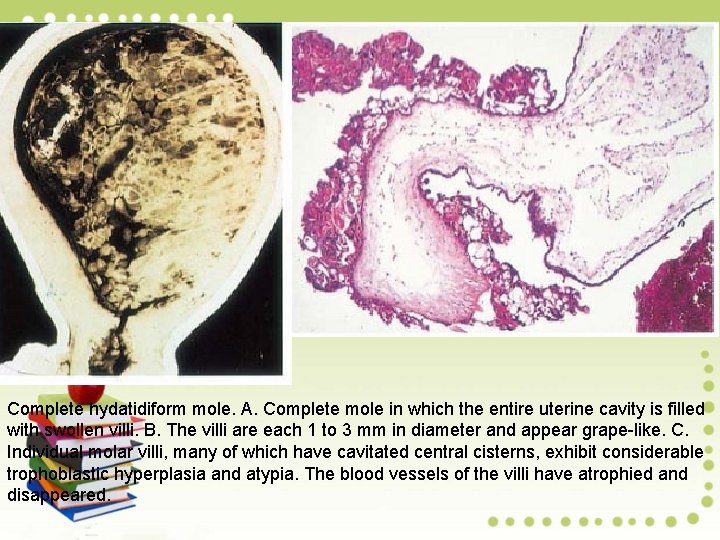 Complete hydatidiform mole. A. Complete mole in which the entire uterine cavity is filled