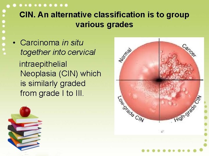 CIN. An alternative classification is to group various grades • Carcinoma in situ together