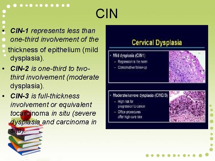 CIN • CIN-1 represents less than one-third involvement of the thickness of epithelium (mild