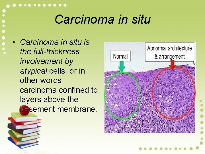 Carcinoma in situ • Carcinoma in situ is the full-thickness involvement by atypical cells,