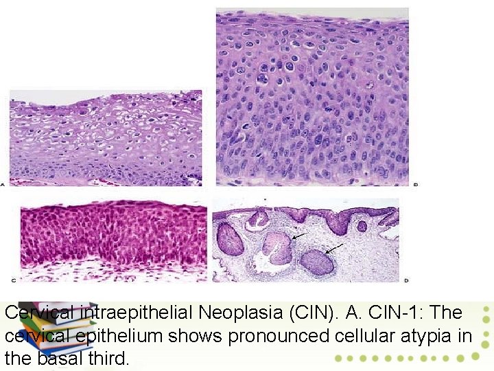 Cervical intraepithelial Neoplasia (CIN). A. CIN-1: The cervical epithelium shows pronounced cellular atypia in