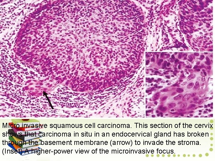 Micro invasive squamous cell carcinoma. This section of the cervix shows that carcinoma in