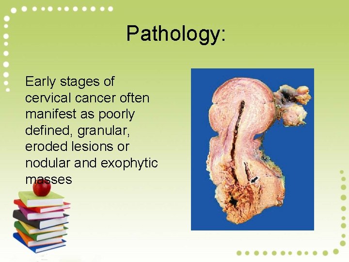 Pathology: Early stages of cervical cancer often manifest as poorly defined, granular, eroded lesions