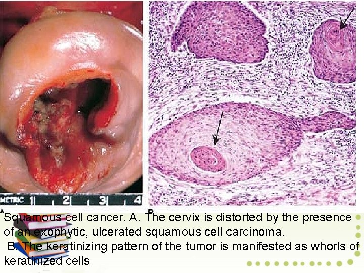 Squamous cell cancer. A. The cervix is distorted by the presence of an exophytic,