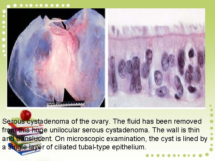 Serous cystadenoma of the ovary. The fluid has been removed from this huge unilocular