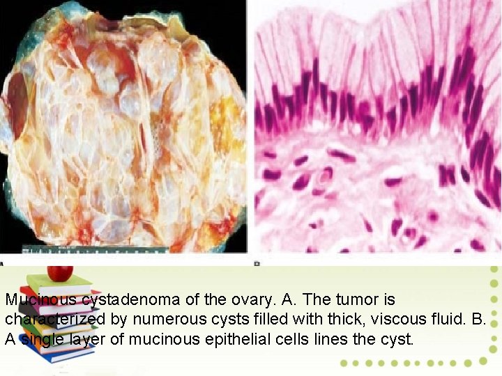 Mucinous cystadenoma of the ovary. A. The tumor is characterized by numerous cysts filled